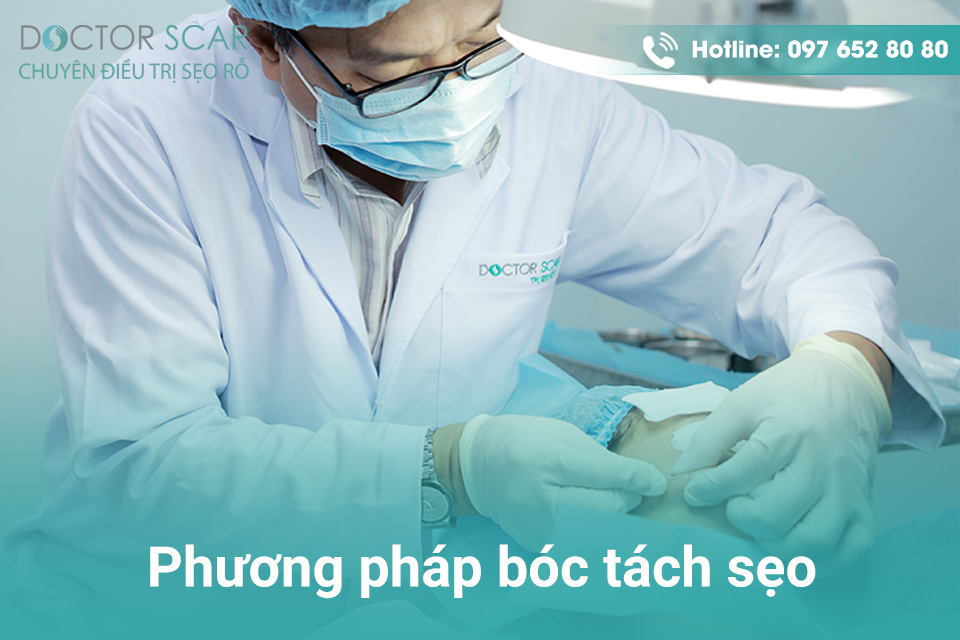 Phương pháp bóc tách sẹo.