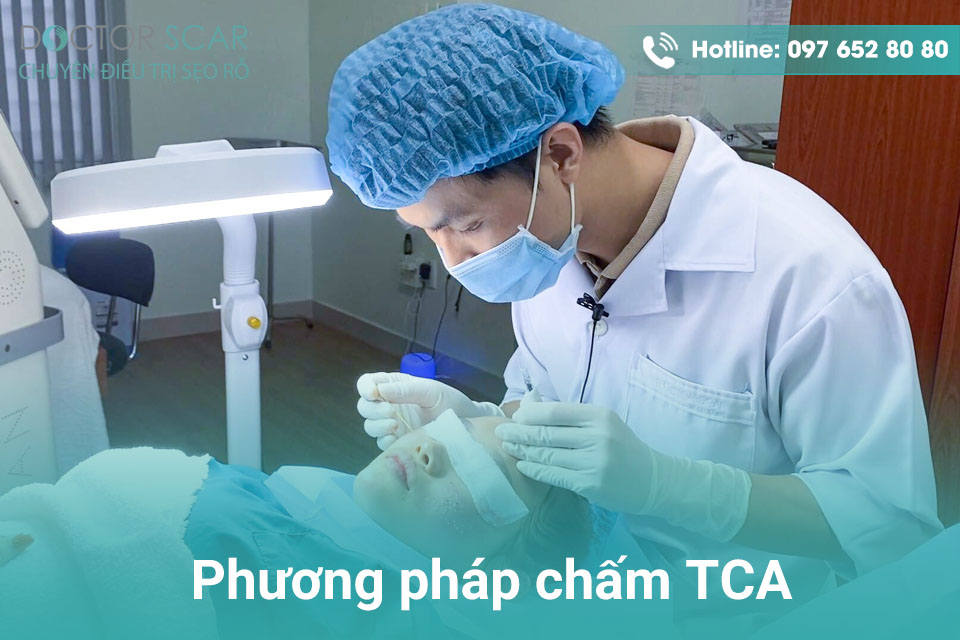 Phương pháp chấm TCA