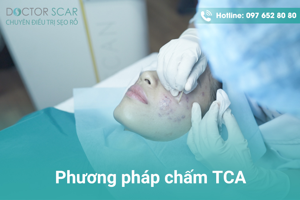 Phương pháp chấm TCA.