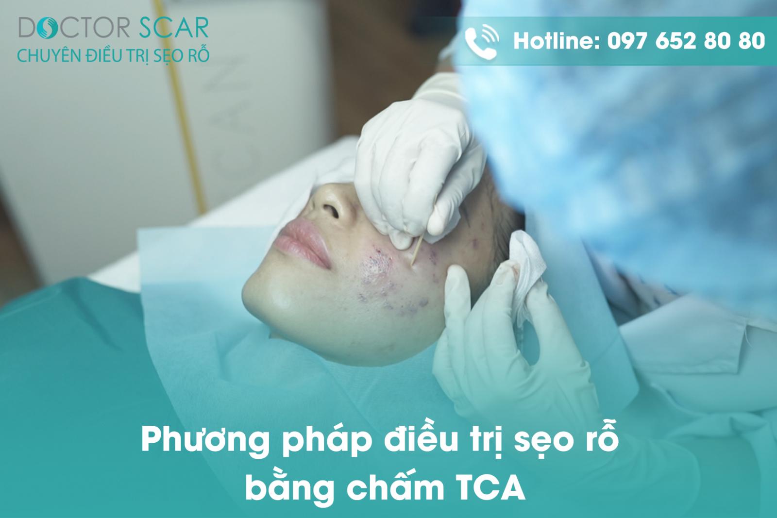 Phương pháp điều trị sẹo rỗ bằng chấm TCA