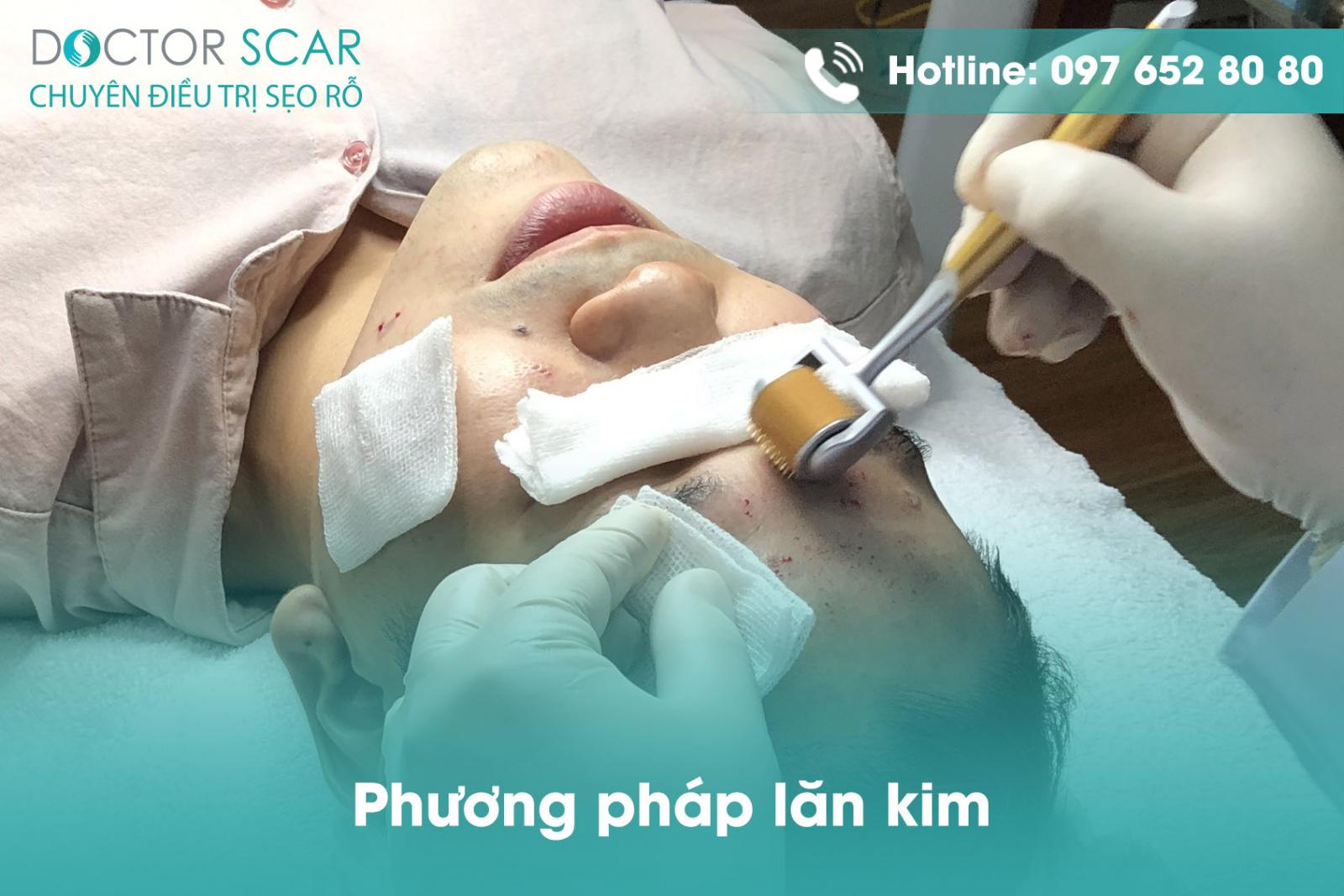 Phương pháp lăn kim