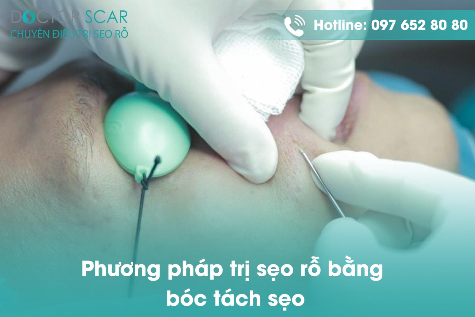 Phương pháp trị sẹo rỗ bằng bóc tách sẹo