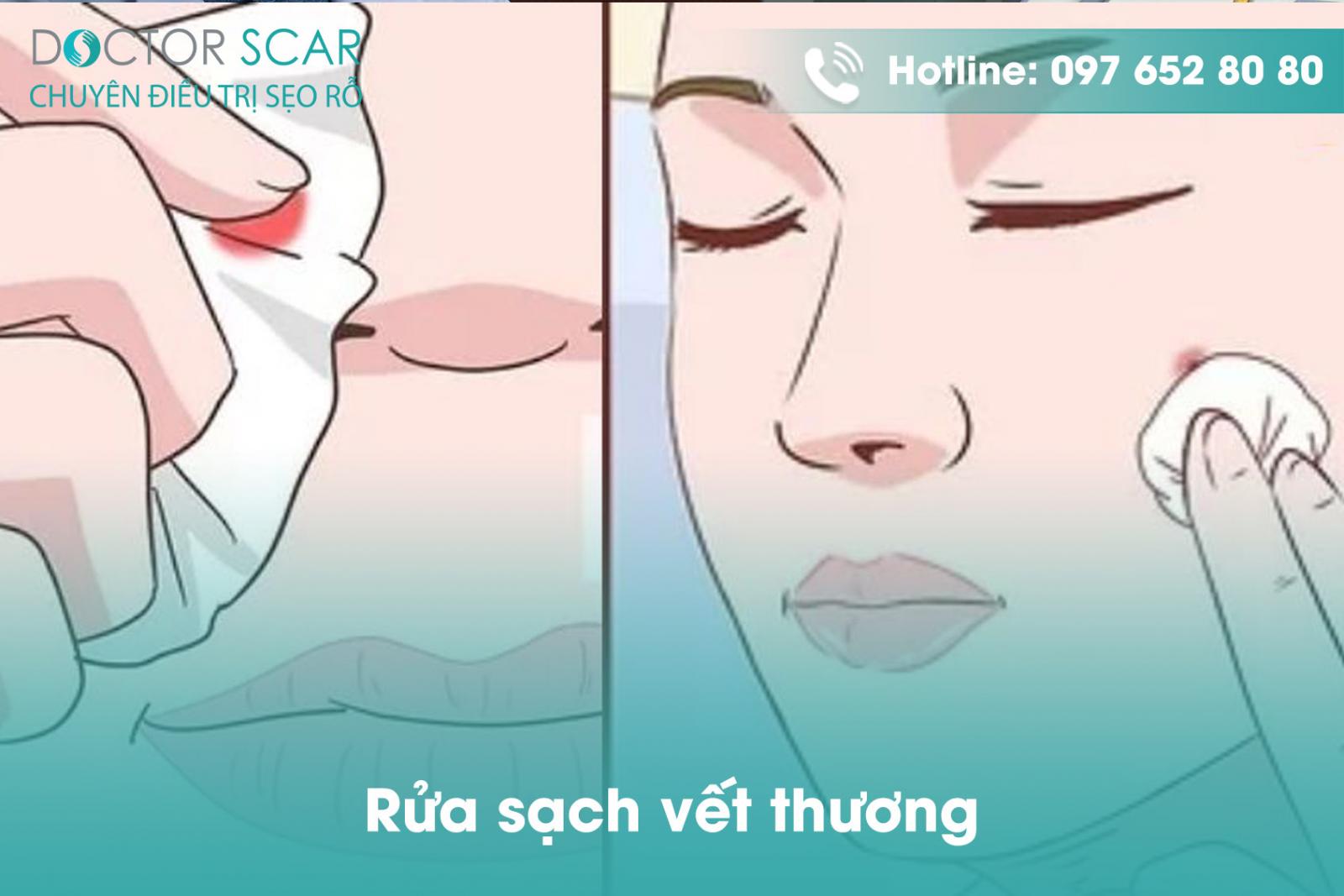 Rửa sạch vết thương