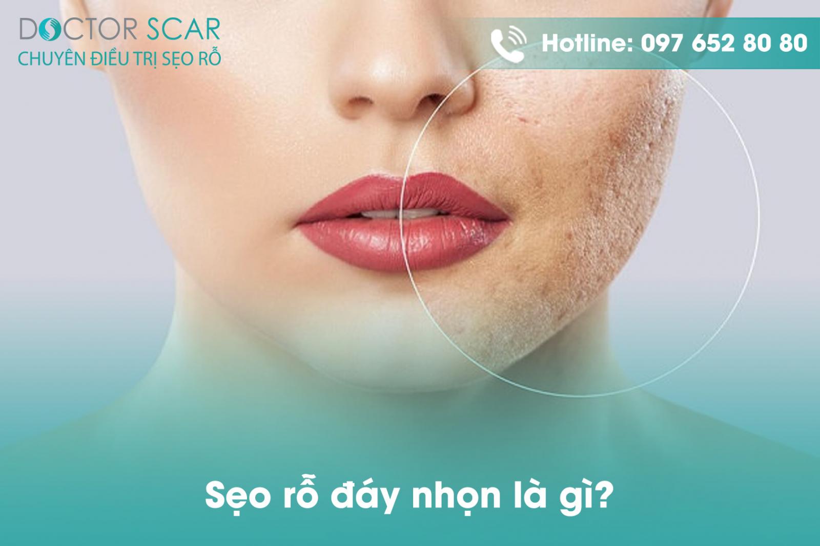 Sẹo đáy nhọn là gì?