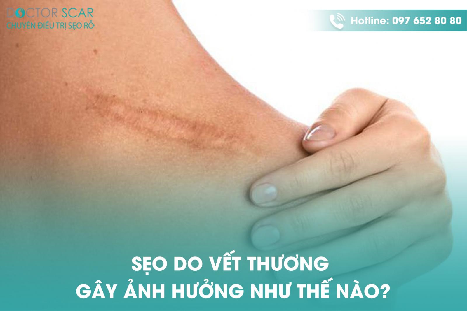 Sẹo do vết thương ảnh hưởng như thế nào?