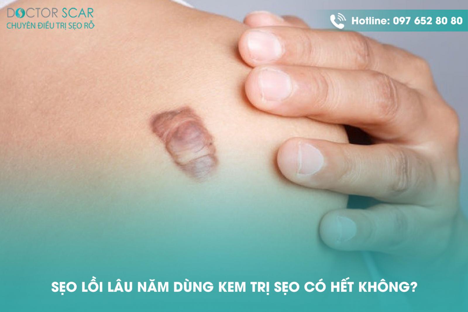 Sẹo lồi lâu năm dùng kem trị sẹo có hết không?