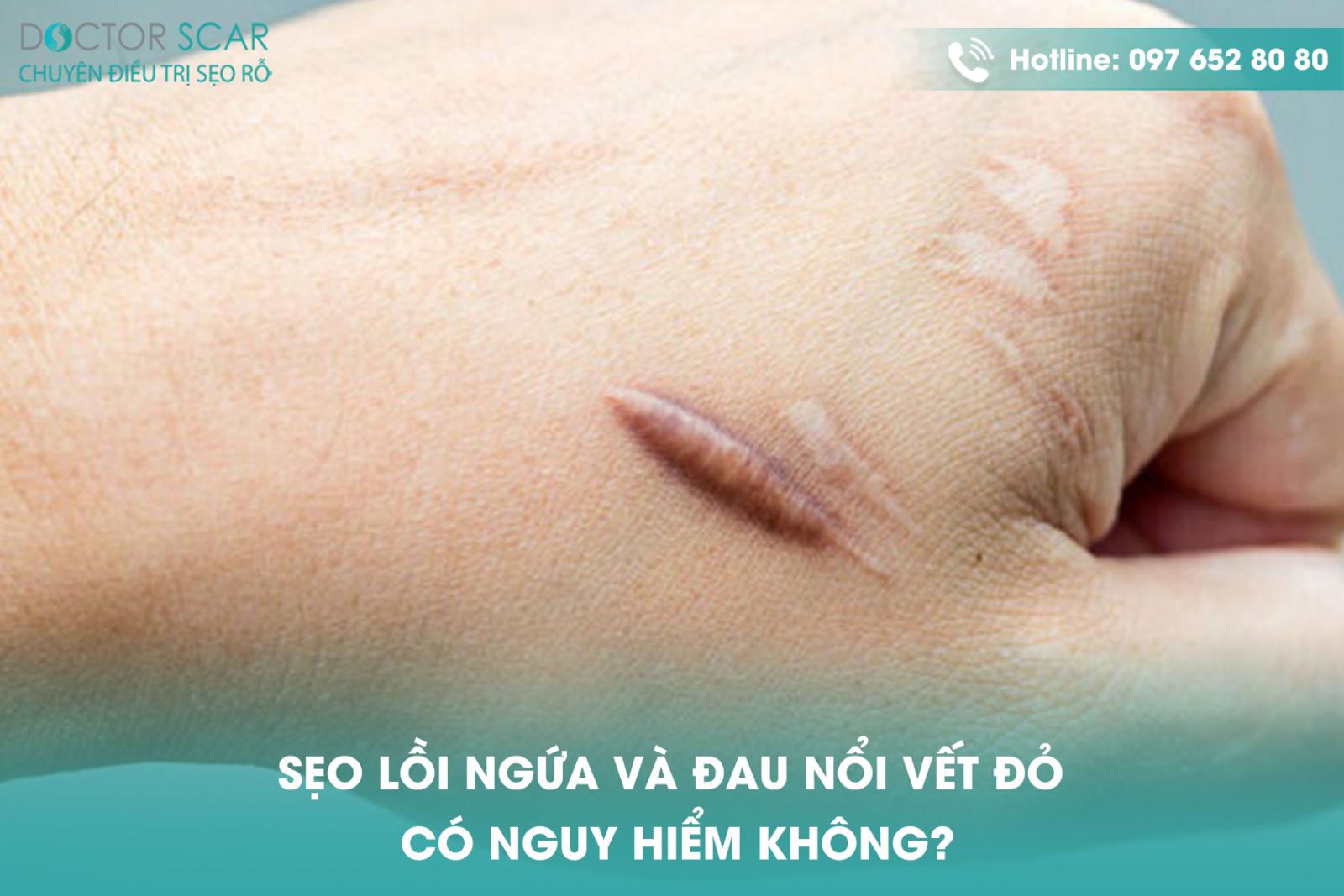 Sẹo lồi ngứa và đau nổi vết đỏ có nguy hiểm không?