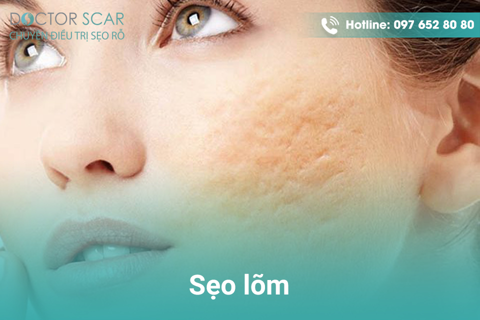 Trị sẹo bằng laser co2 fractional