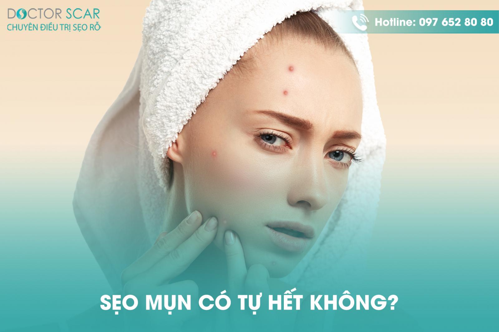 Sẹo mụn có chữa được không?