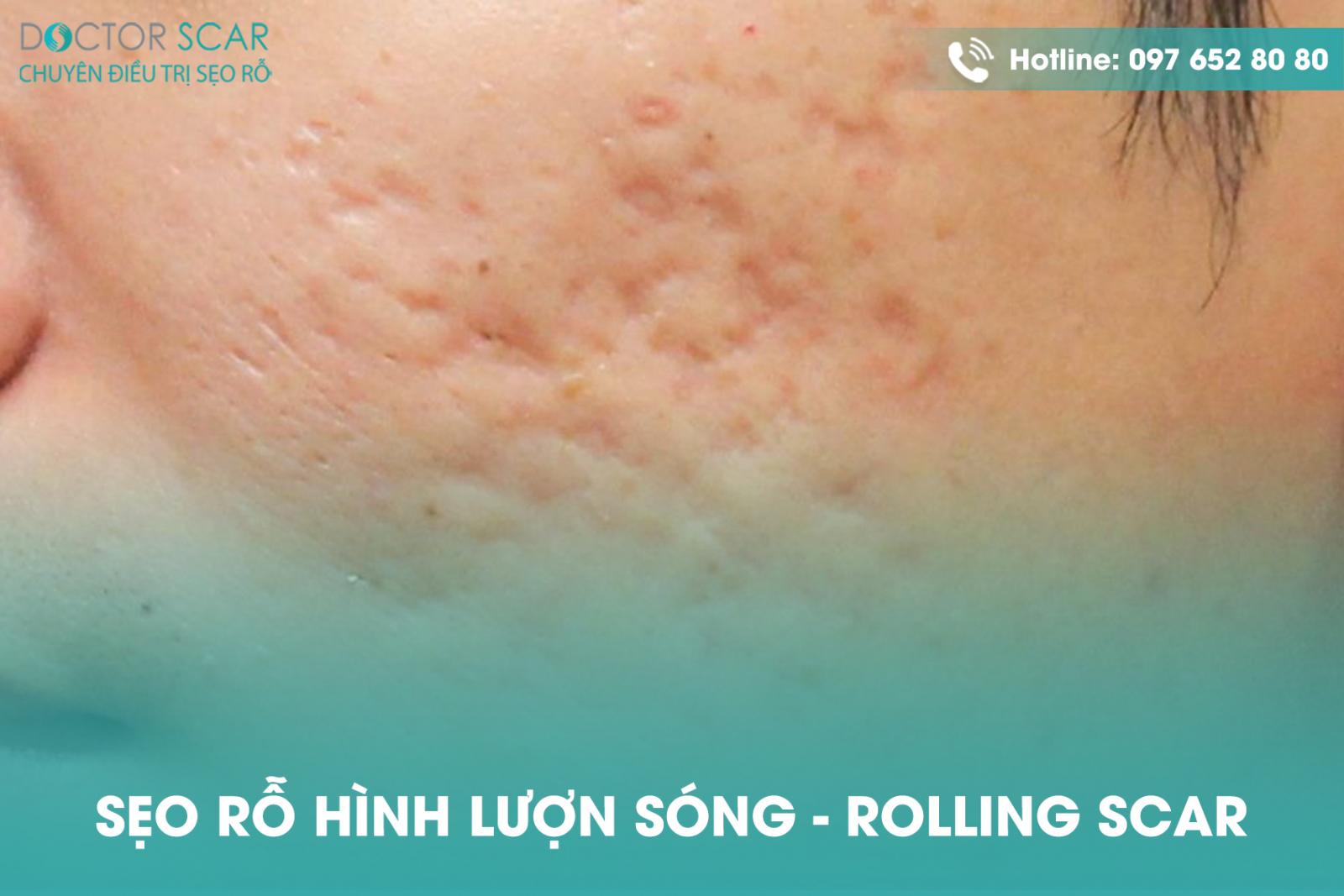 Sẹo rỗ hình lượn sóng.