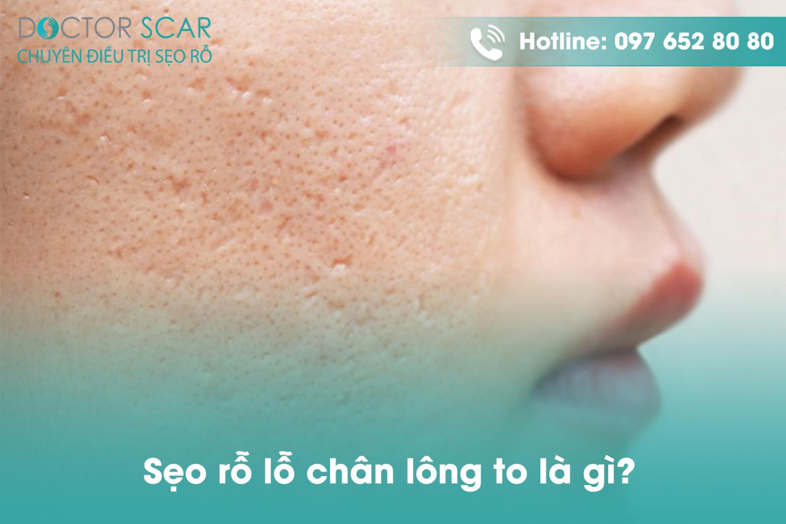 Sẹo rỗ lỗ chân lông to là gì?