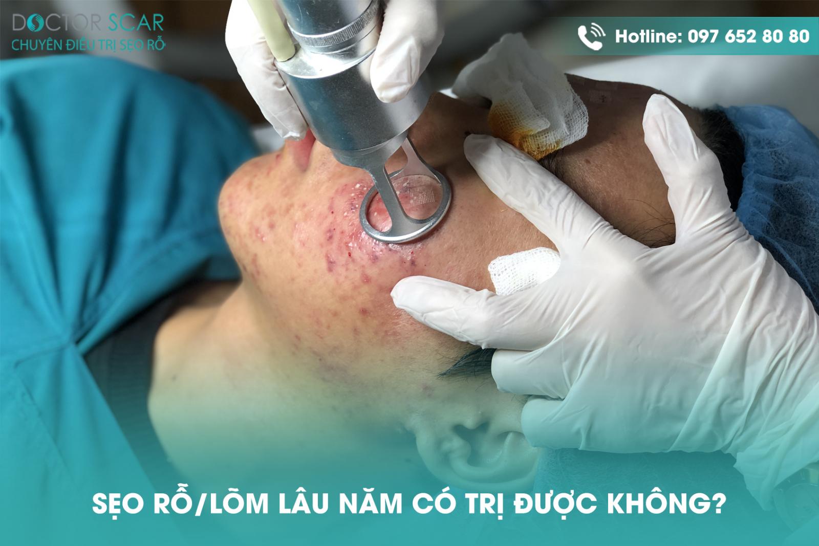 Sẹo rỗ, sẹo lõm lâu năm có trị được không?