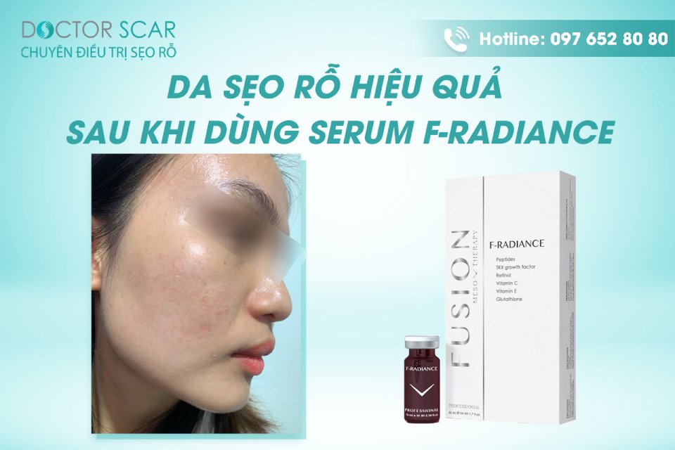 Sử dụng serum f-radiance hiệu quả rõ rệt sau 4-6 tuần điều trị