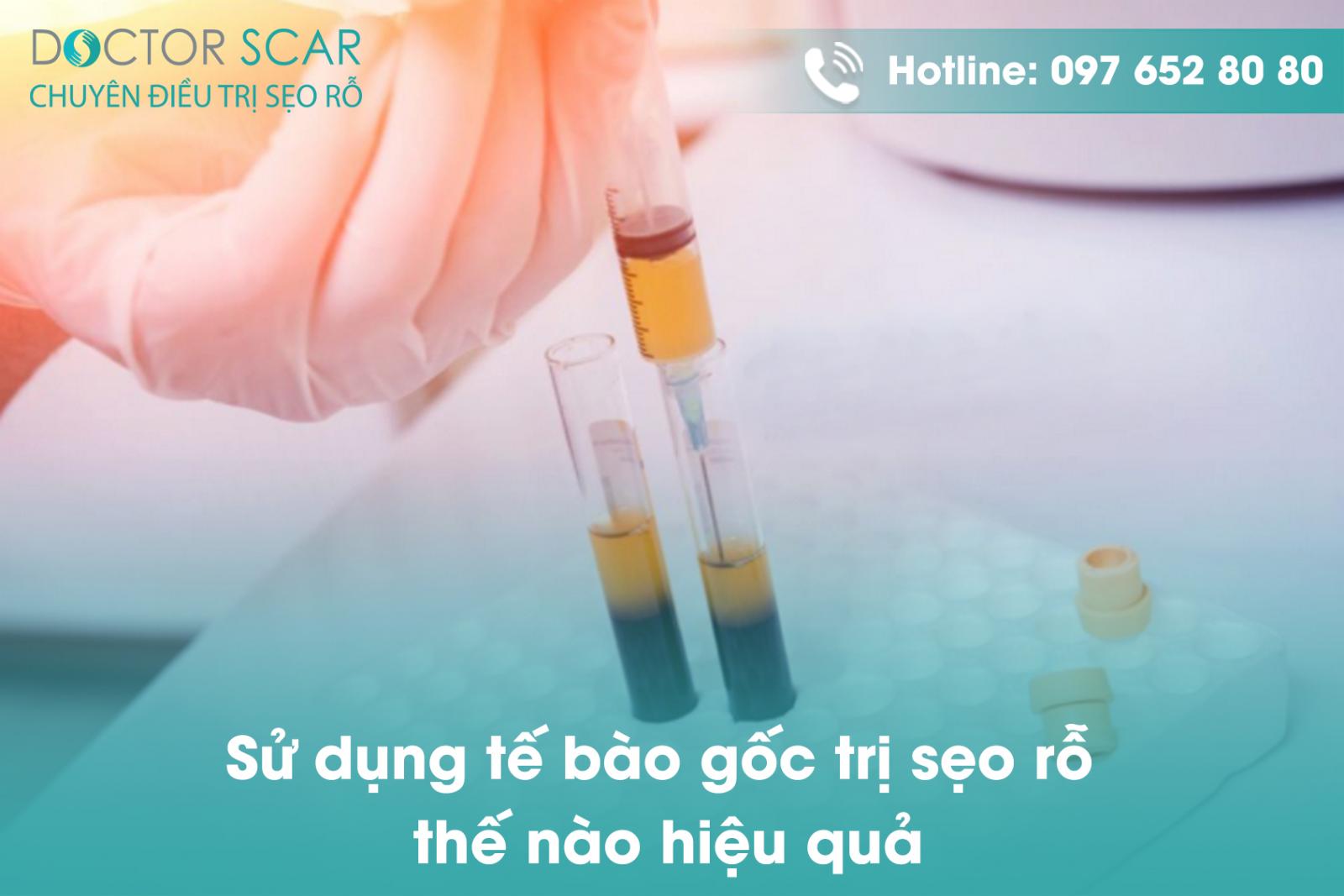 Sử dụng tế bào gốc trị sẹo rỗ thế nào hiệu quả