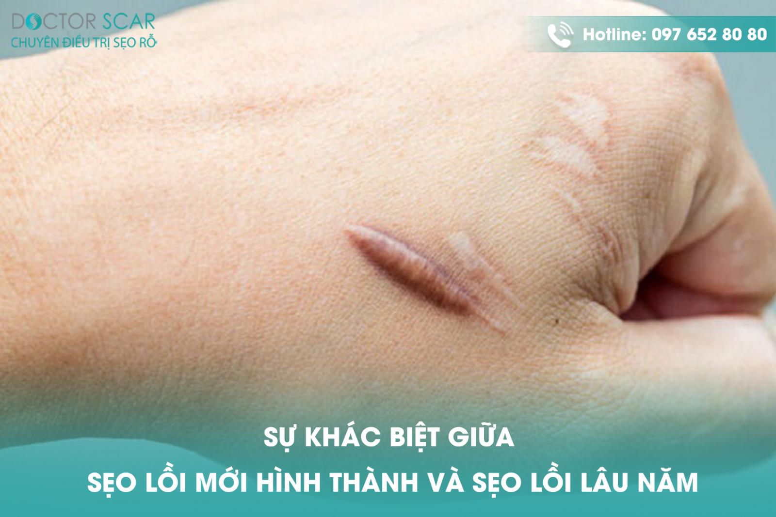 Sự khác biệt giữa sẹo lồi mới hình thành và sẹo lồi lâu năm