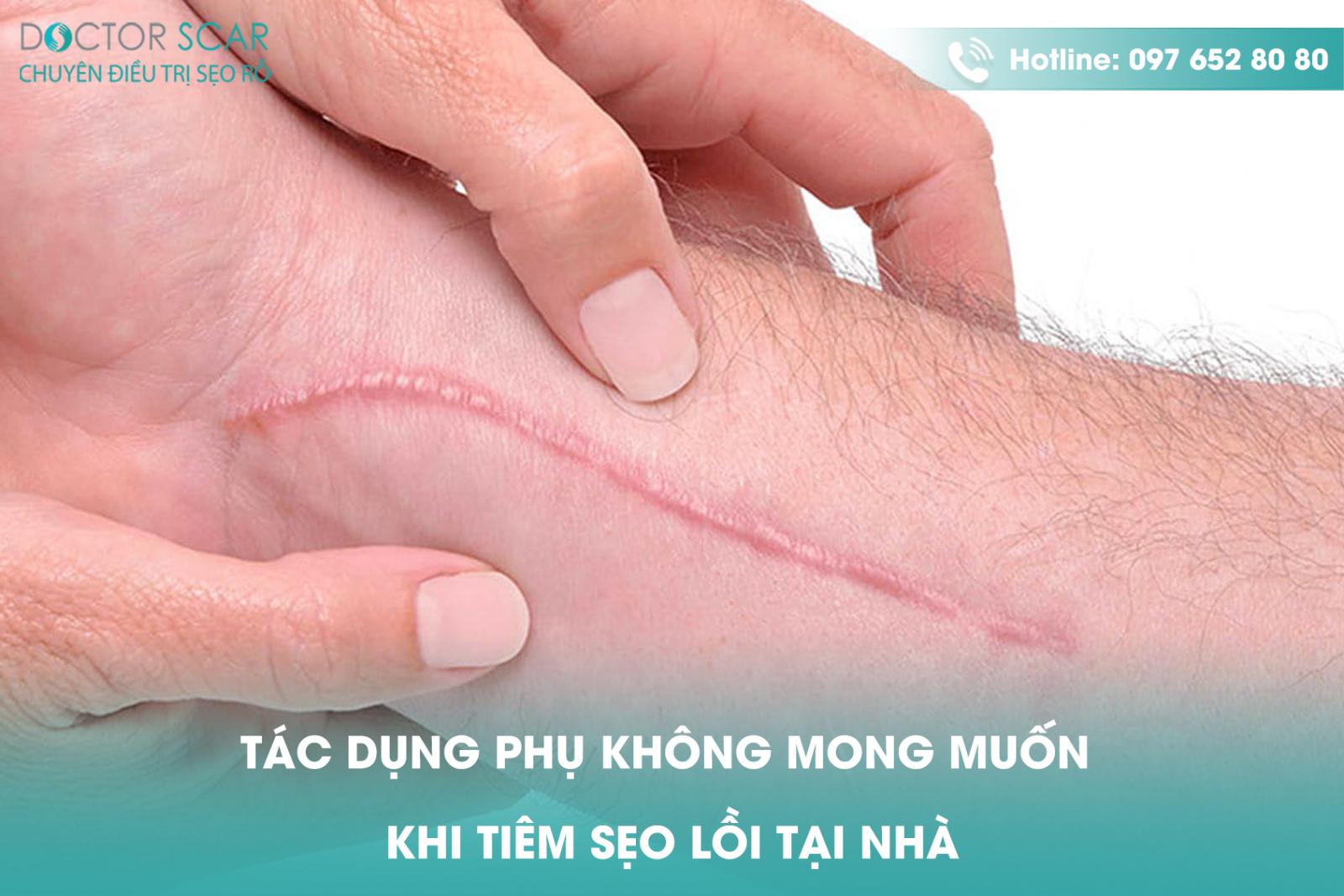 Tác dụng phụ không mong muốn khi tiêm sẹo lồi tại nhà