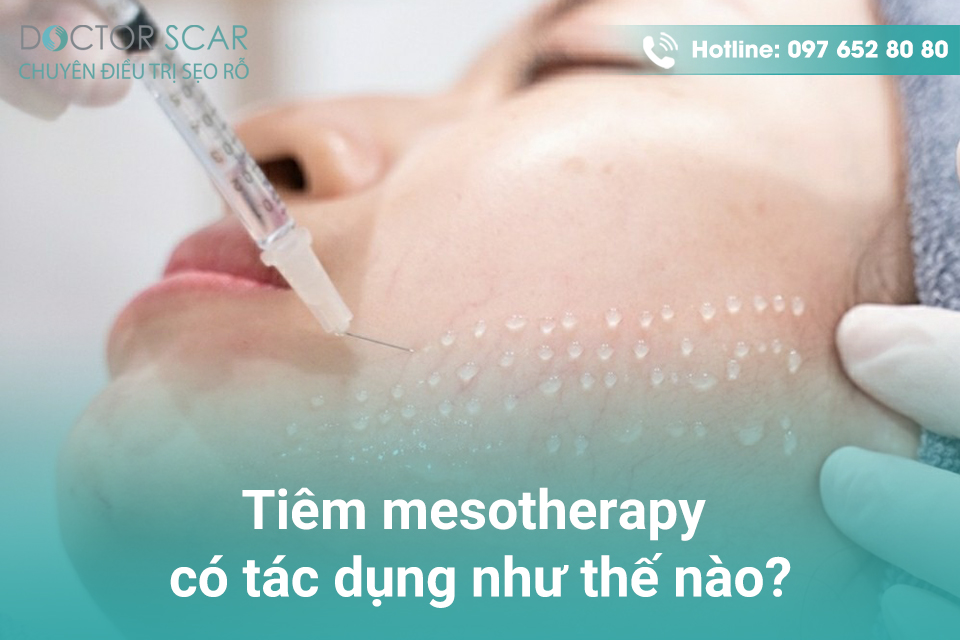 Tiêm mesotherapy có tác dụng như thế nào?