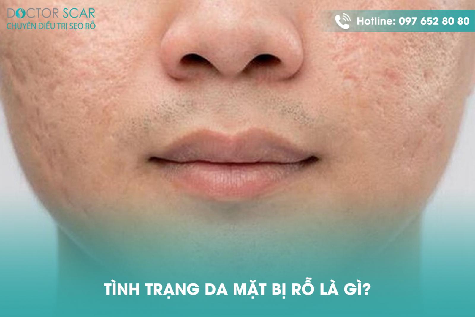 Tình trạng da mặt bị rỗ là gì?