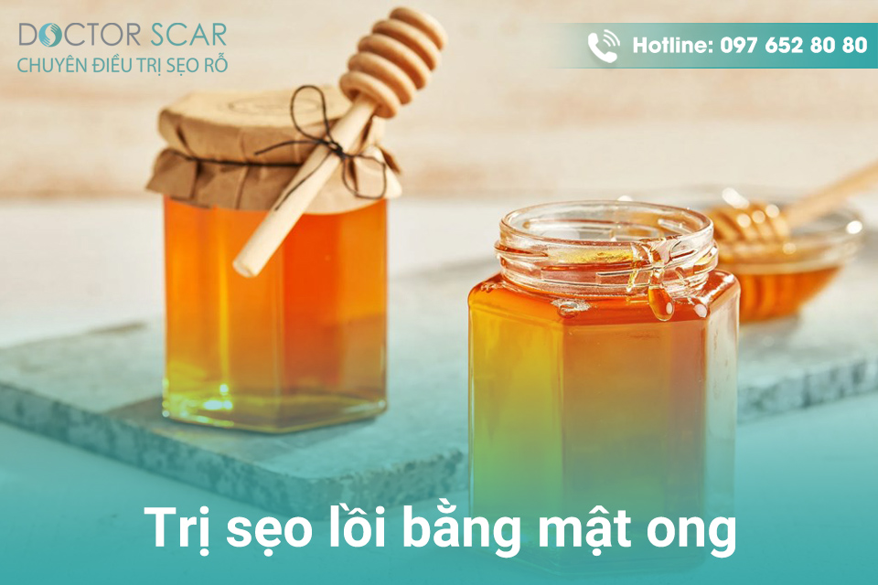 Trị sẹo lồi bằng mật ong.