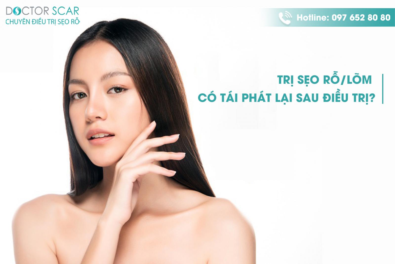 Trị sẹo rỗ/lõm có tái phát lại sau điều trị?