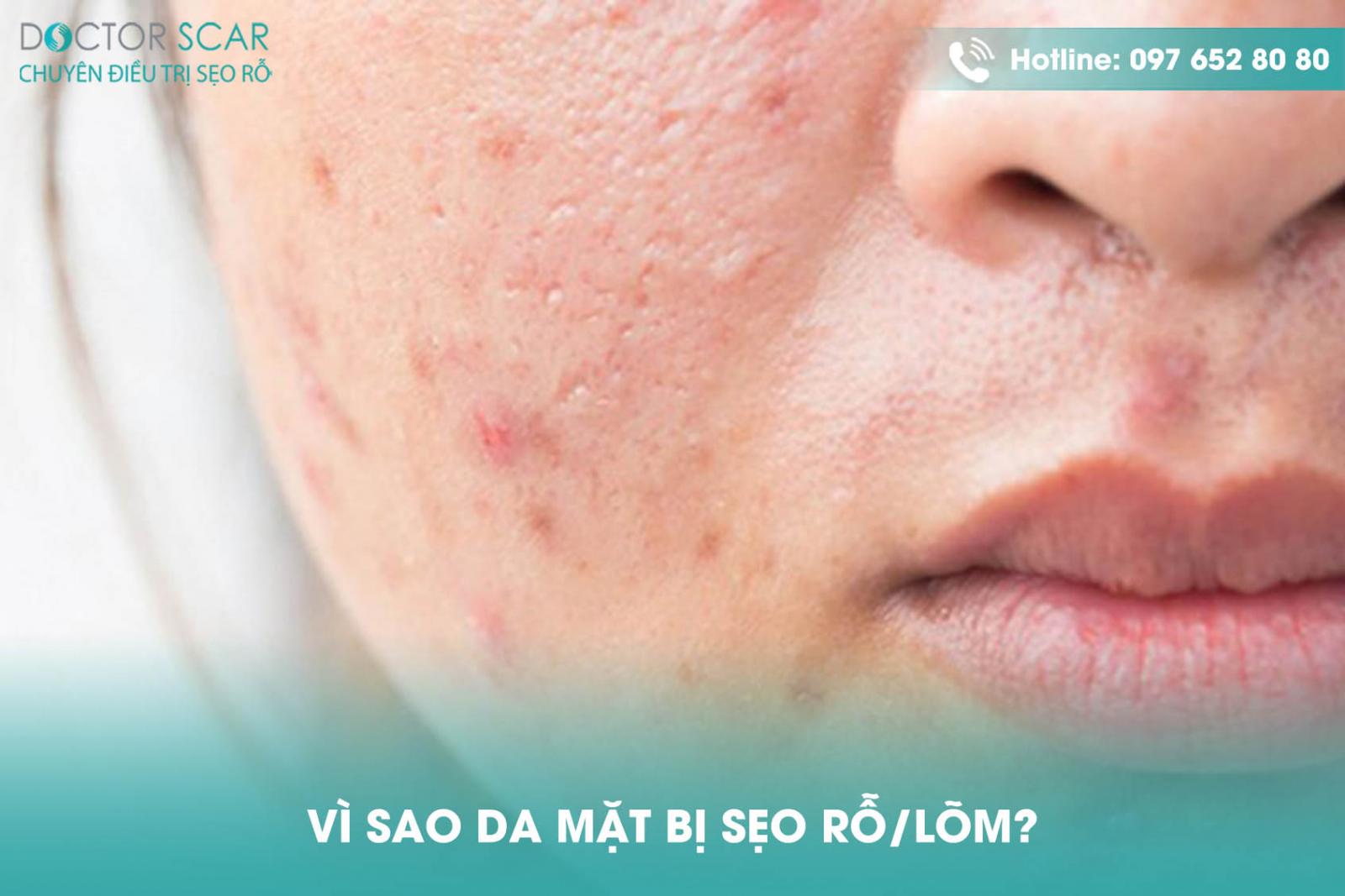 Vì sao da mặt bị sẹo rỗ/lõm?