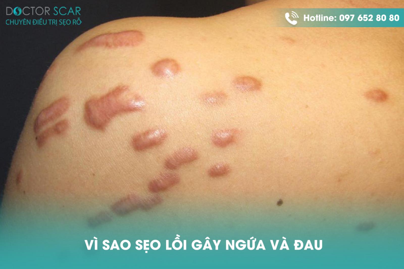 Vì sao sẹo lồi gây ngứa và đau?