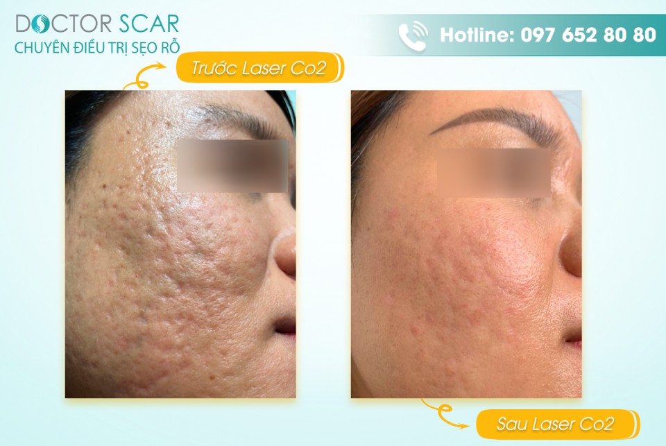 Ảnh trước và sau điều trị sẹo rỗ tại Doctor Scar