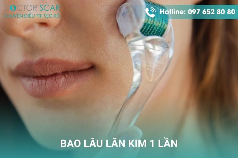 Lăn kim tại nhà bao lâu 1 lần.