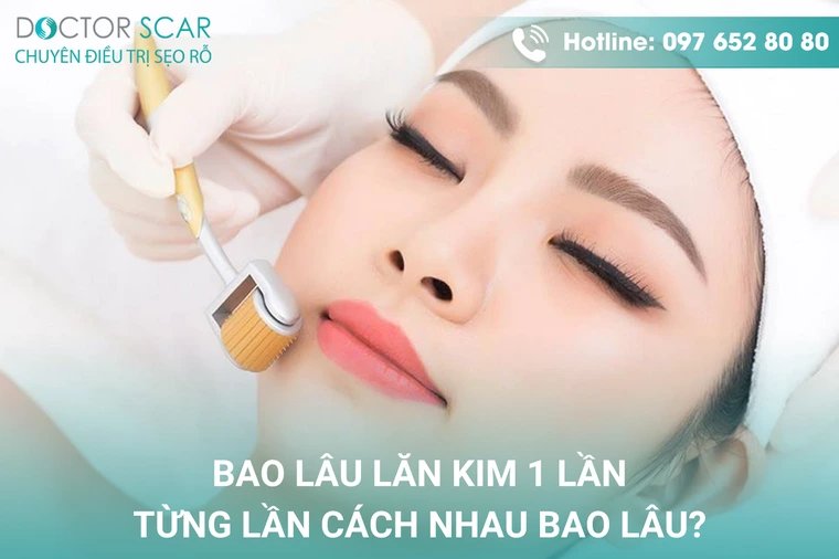 Lăn kim bao nhiêu lần thì đẹp da