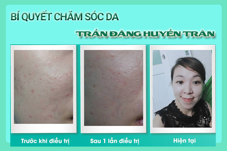 bi-quyet-cham-soc-da-tu-kinh-nghiem-dieu-tri-seo-ro-1