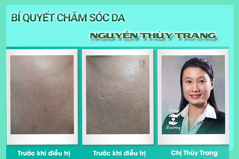 bi-quyet-cham-soc-da-tu-kinh-nghiem-dieu-tri-seo-ro-2