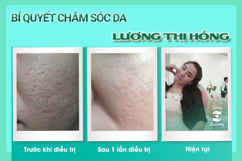 bi-quyet-cham-soc-da-tu-kinh-nghiem-dieu-tri-seo-ro-3