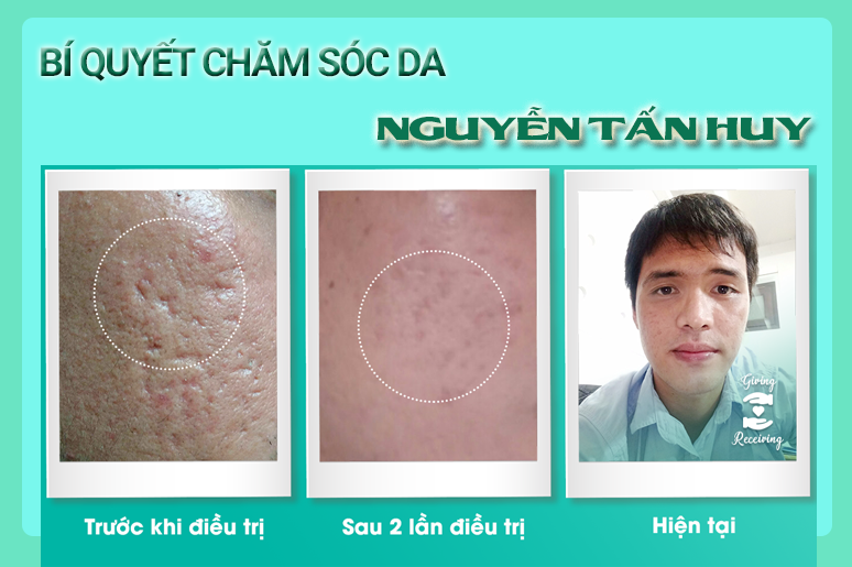 bi-quyet-cham-soc-da-tu-kinh-nghiem-dieu-tri-seo-ro-4