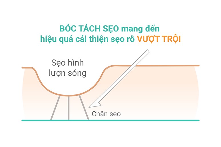 bóc tách cắt đáy sẹo rỗ là gì