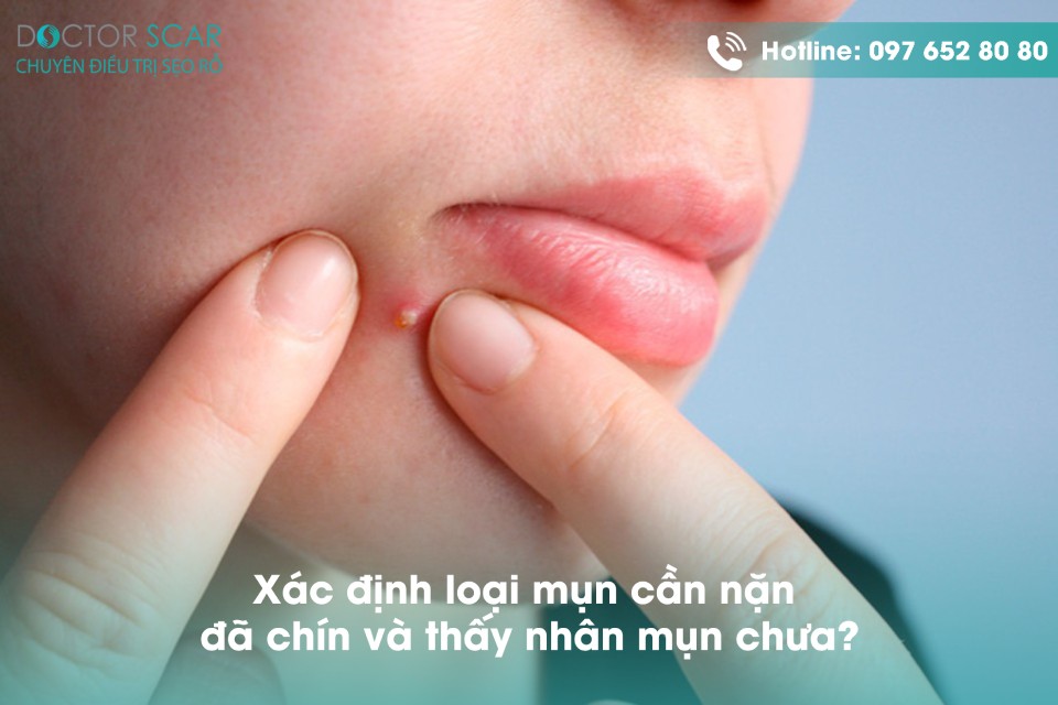 7 cách nặn mụn không để lại sẹo rỗ