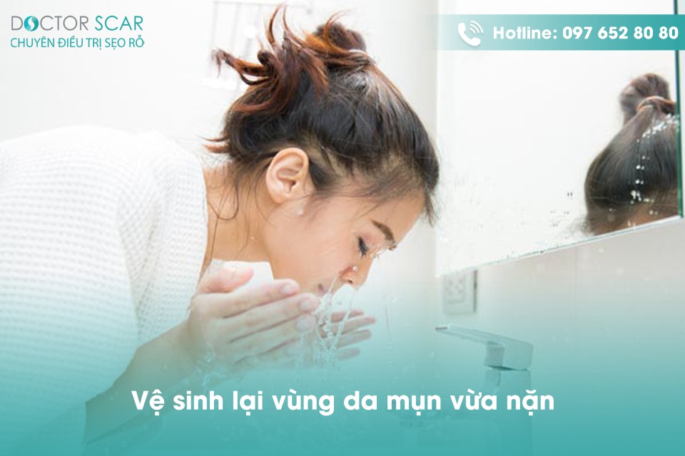 Rửa sạch lại vùng da bị mụn sau khi nặn