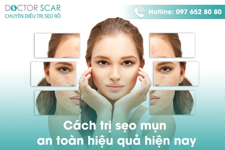 Cách trị sẹo mụn an toàn hiệu quả