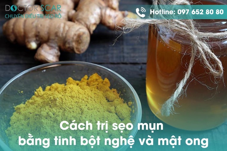 Cách trị sẹo mụn bằng mật ong và nghệ