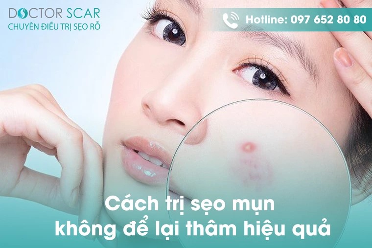 Cách trị sẹo mụn không để lại thâm hiệu quả