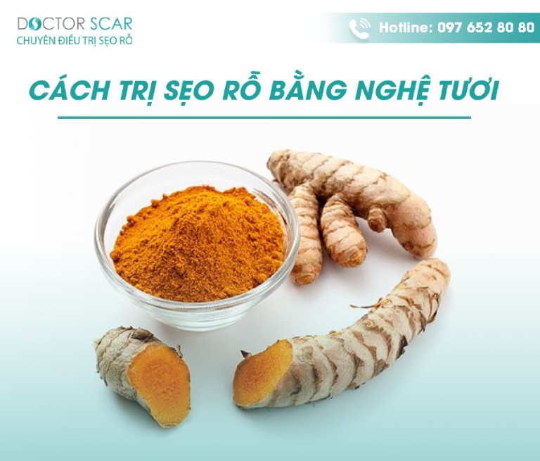 6+ cách trị sẹo bằng bột nghệ đơn giản, hiệu quả tại nhà