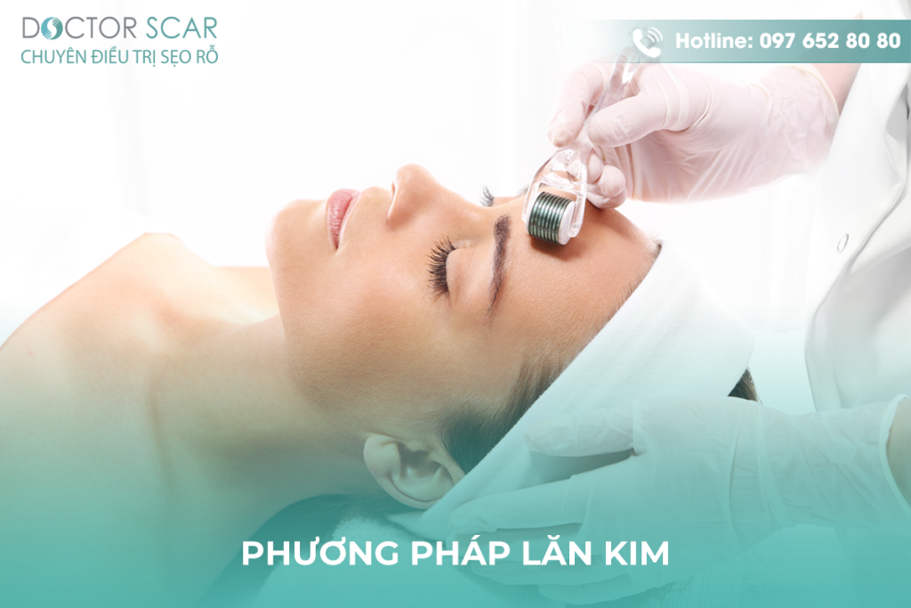 Trị sẹo thâm bằng phương pháp lăn kim