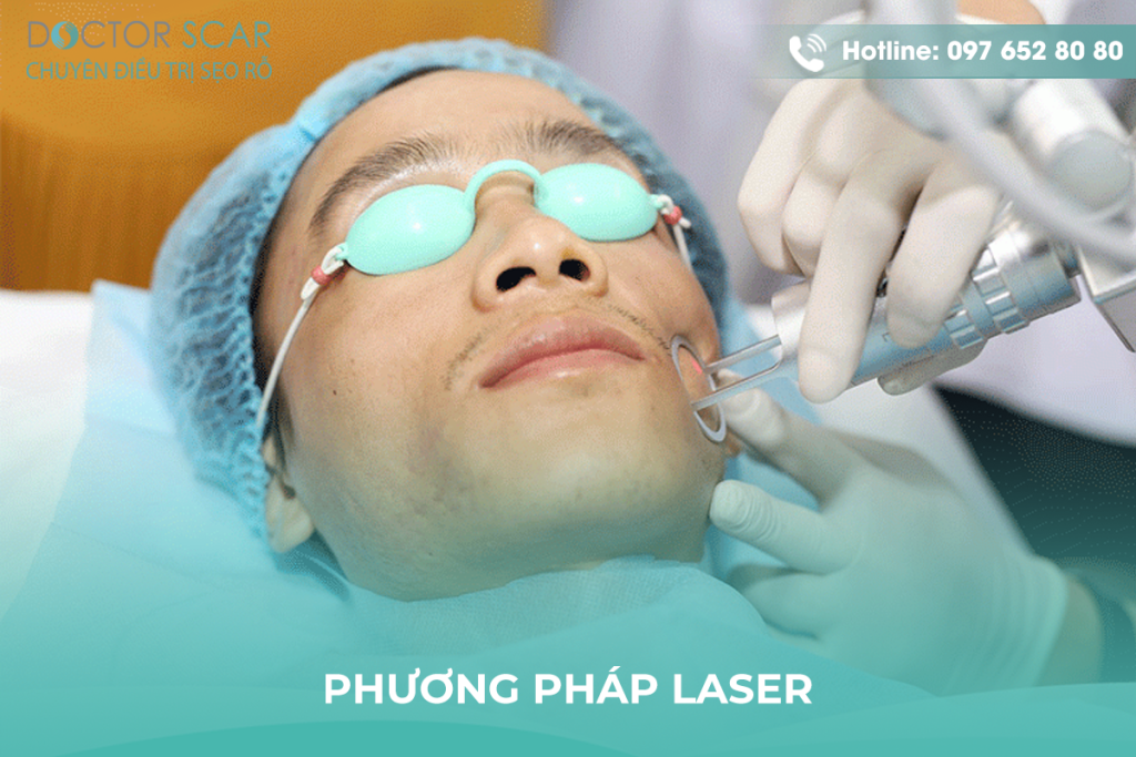 Phương pháp laser