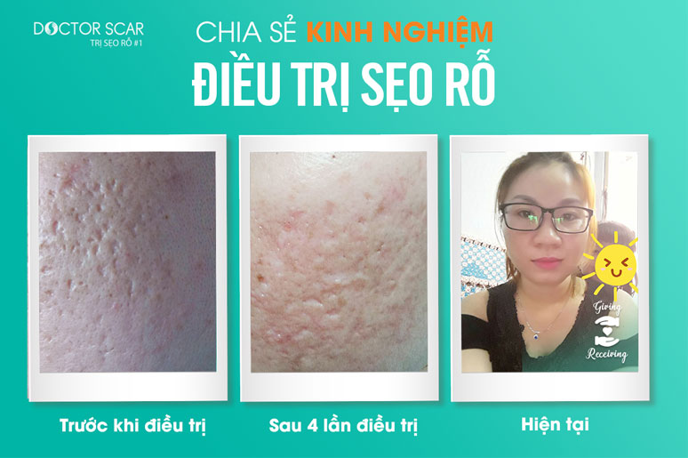 chia-se-kinh-nghiem-dieu-tri-seo-ro-2