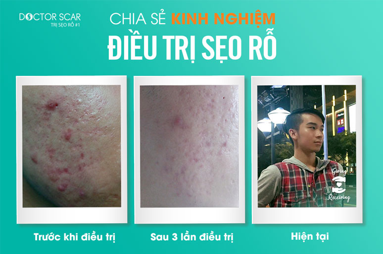 chia-se-kinh-nghiem-dieu-tri-seo-ro-3