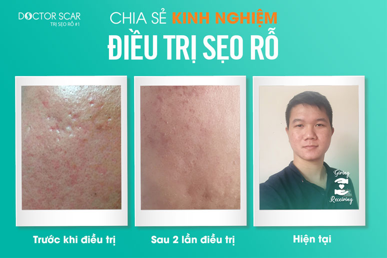 chia-se-kinh-nghiem-dieu-tri-seo-ro-4