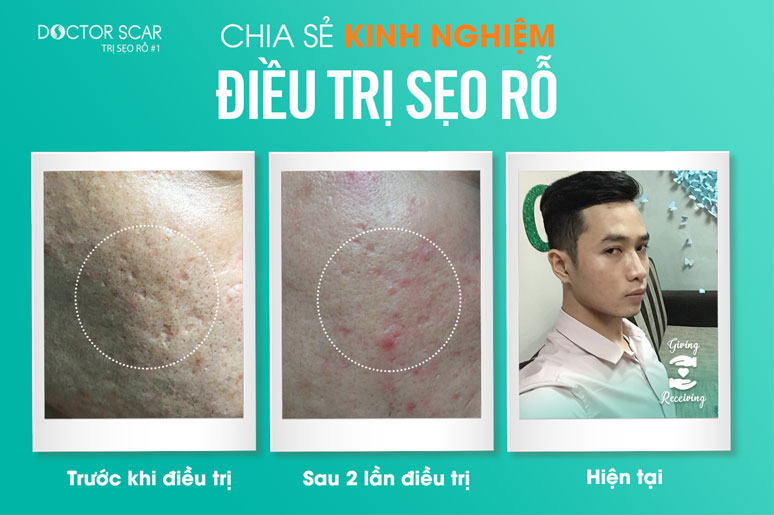 chia-se-kinh-nghiem-dieu-tri-seo-ro-5