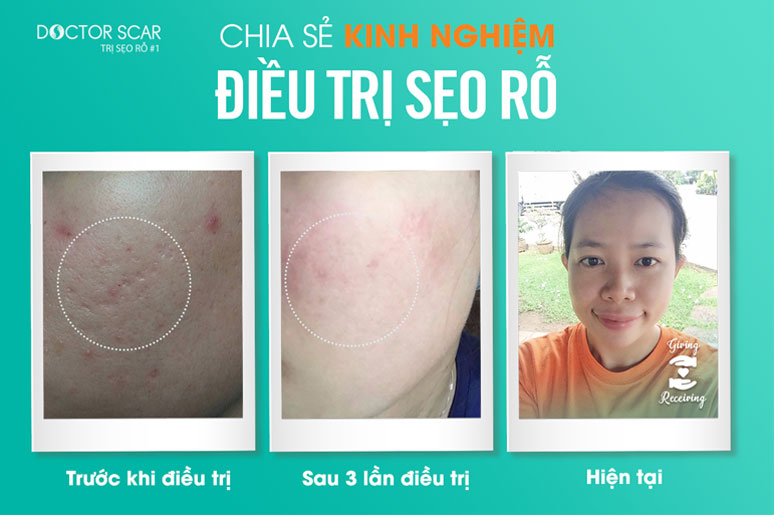 chia-se-kinh-nghiem-dieu-tri-seo-ro-6