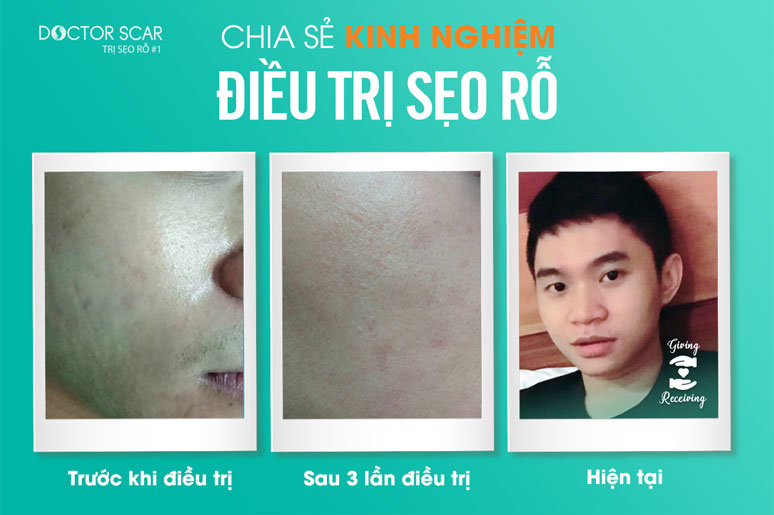 chia-se-kinh-nghiem-dieu-tri-seo-ro-7