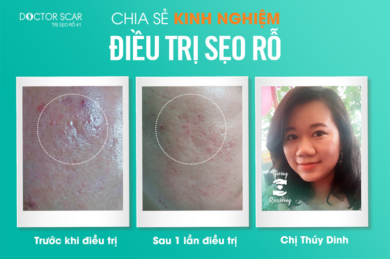 chia-se-kinh-nghiem-dieu-tri-seo-ro-Luong-Thuy-Dinh