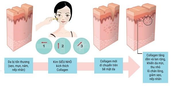 Lăn kim trị mụn có tốt không?